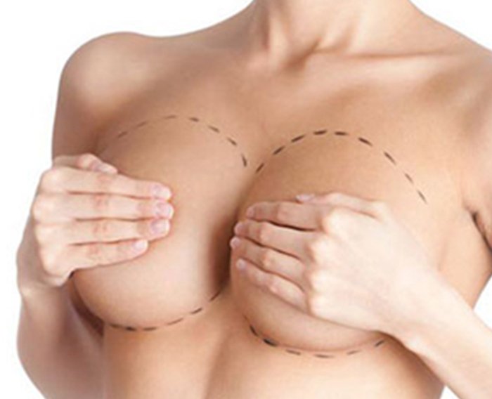 Breast Augmentation