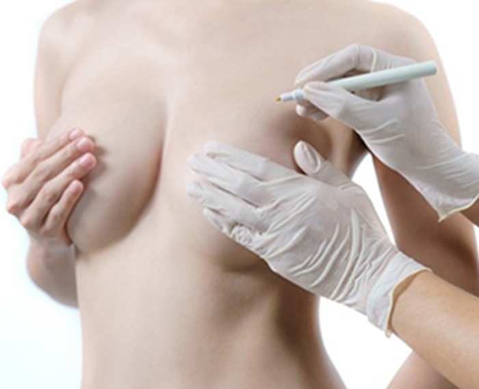 Breast Reduction & Breast Uplift